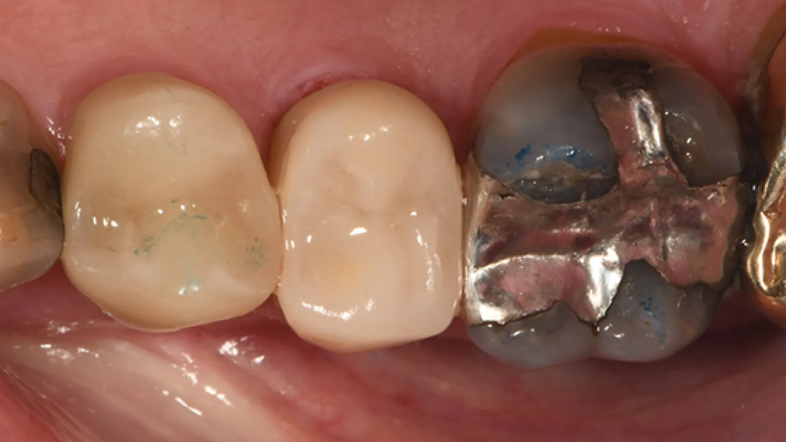 Close-up of molar teeth showing dental crowns and a silver amalgam filling on one tooth.