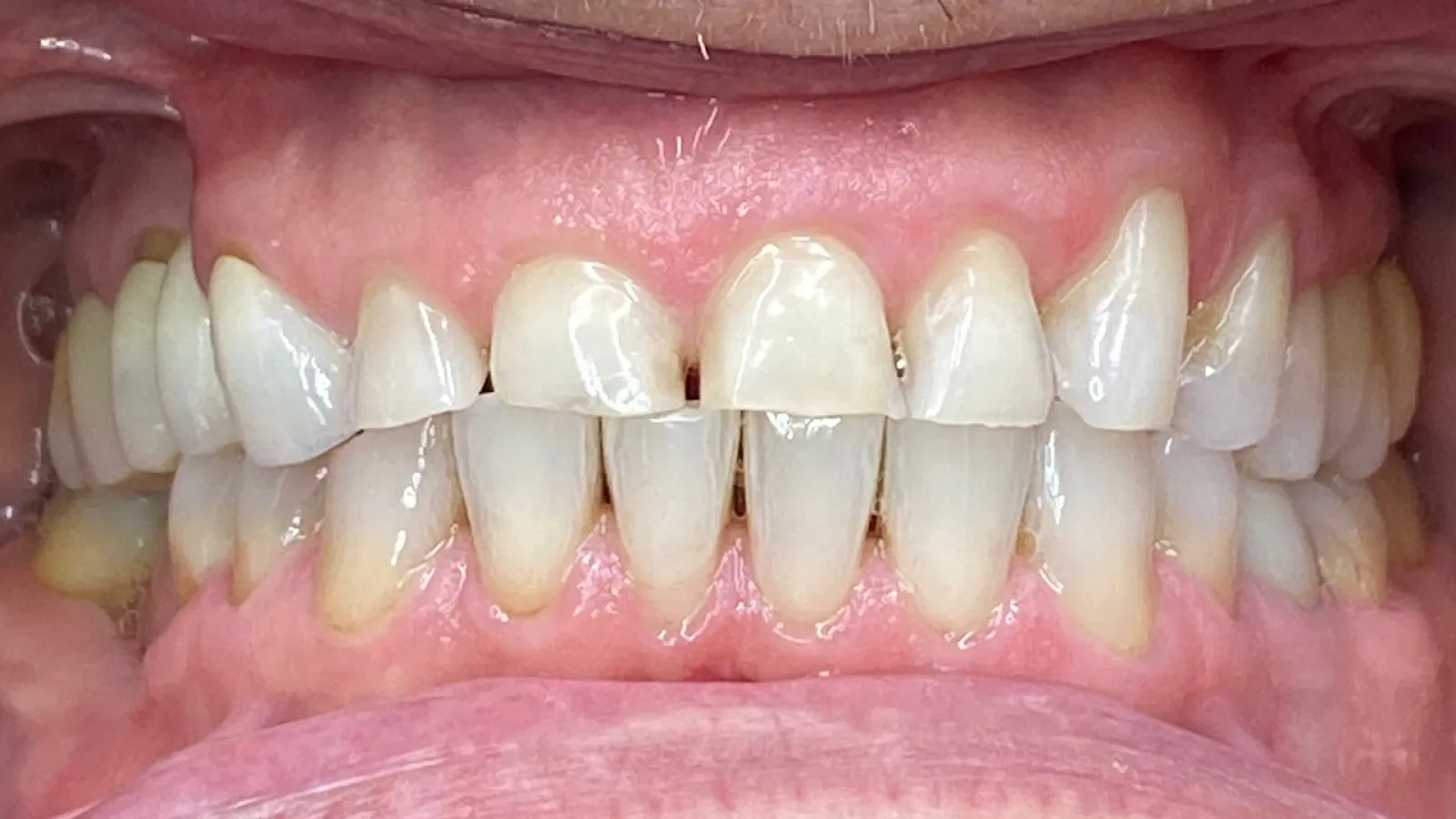 Close-up of human teeth with signs of wear, discoloration, and chipped front teeth.