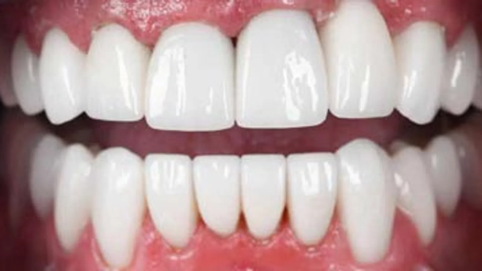 Close-up of bright white and perfectly aligned upper and lower teeth with healthy pink gums.