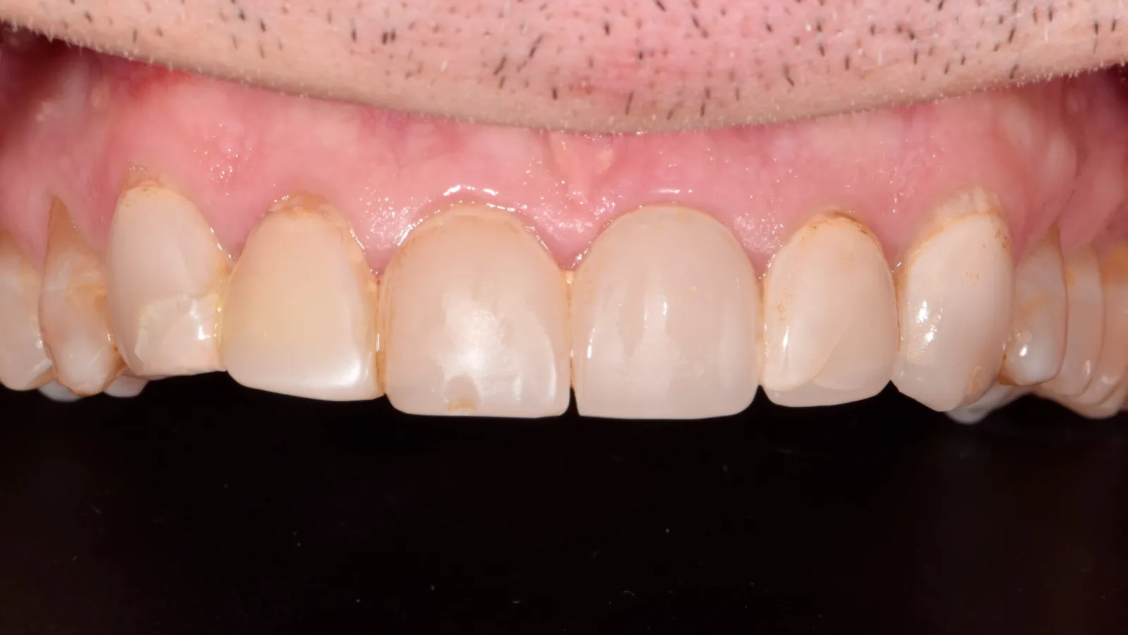 Close-up of upper front teeth showing discoloration, stains, and slight dental wear against a black background.