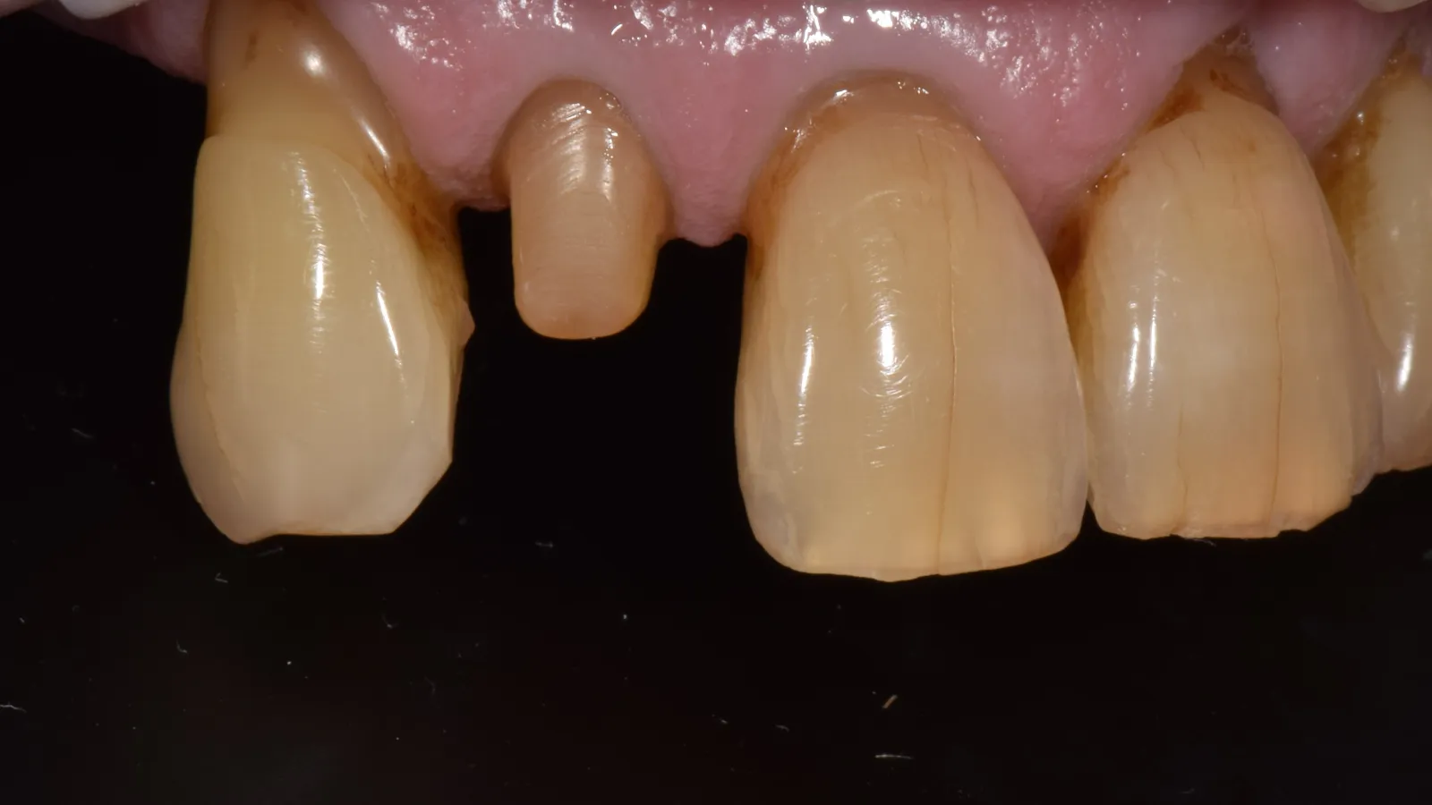 Close-up of upper front teeth with one tooth prepared for dental crown and discoloration on adjacent teeth.