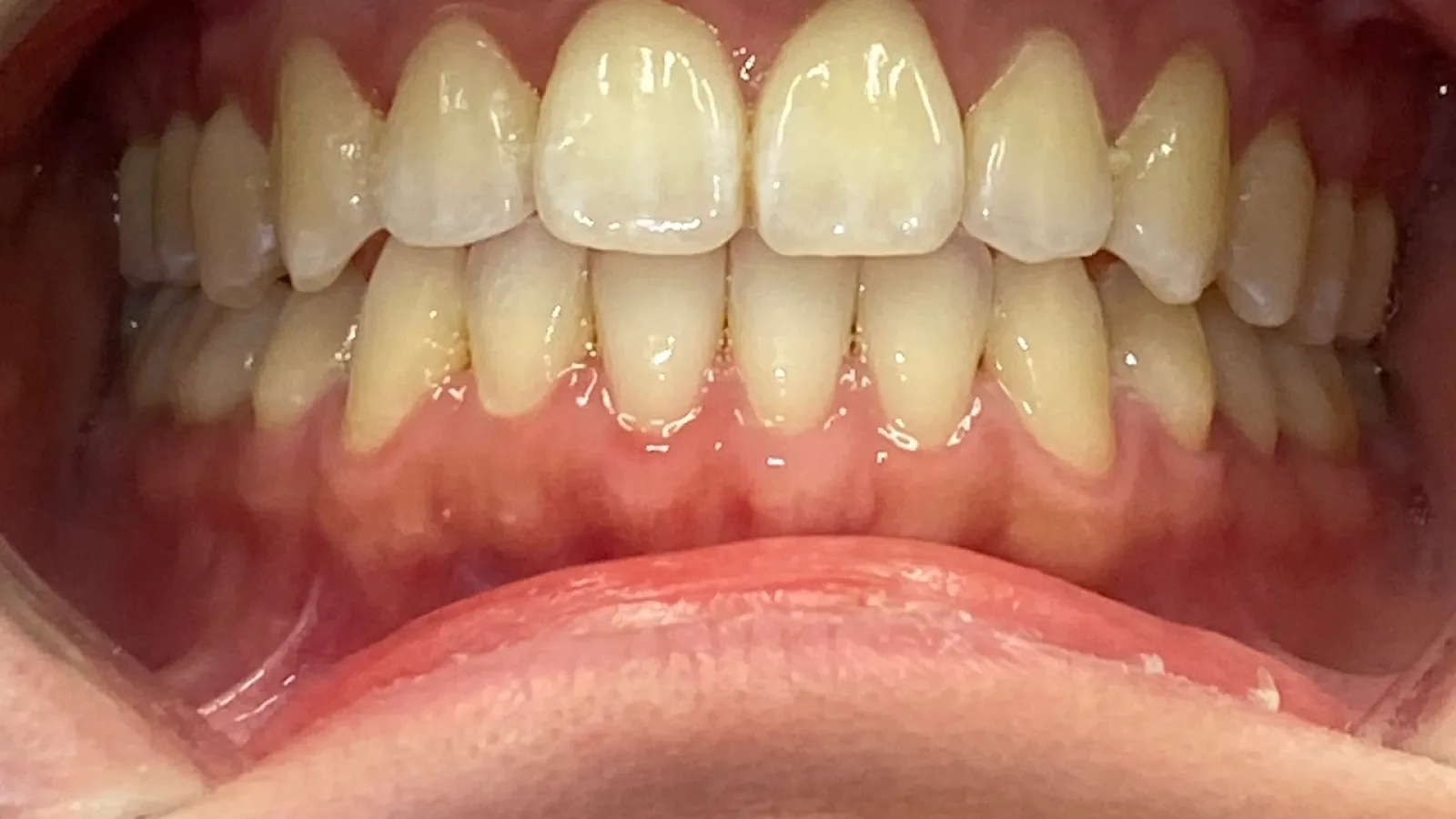 Close-up of healthy upper and lower teeth with gums, showing natural color and alignment.