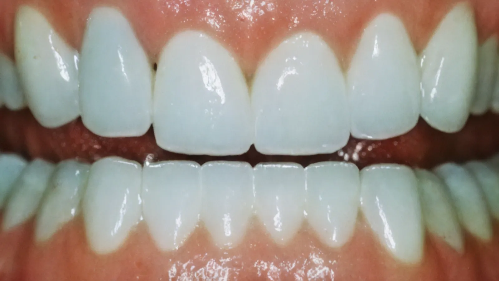 Closeup of healthy, white upper and lower teeth with gums in a smiling mouth.