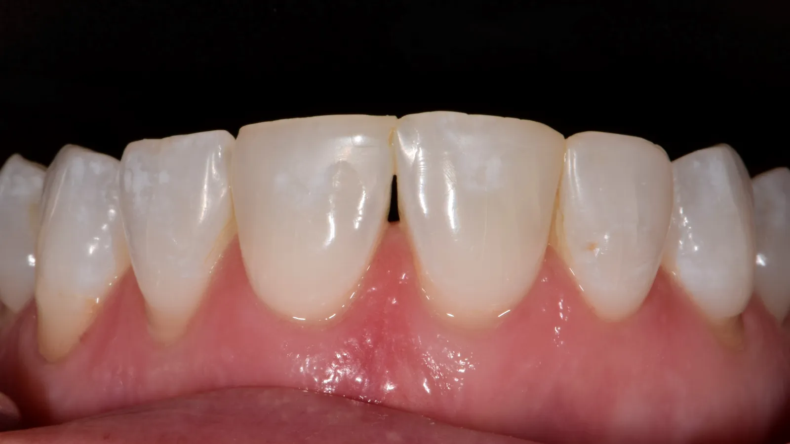 Close-up of front upper teeth with healthy gums and slight spacing between central incisors.