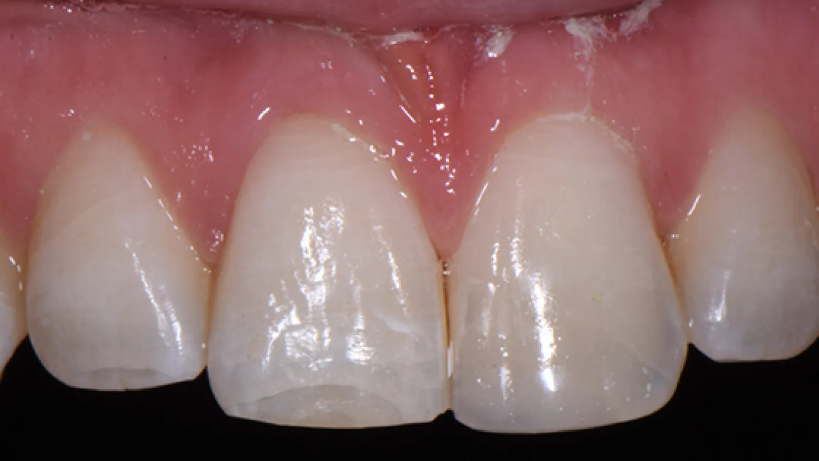 Close-up of upper front teeth with slight chipping and clear dental enamel under natural light.
