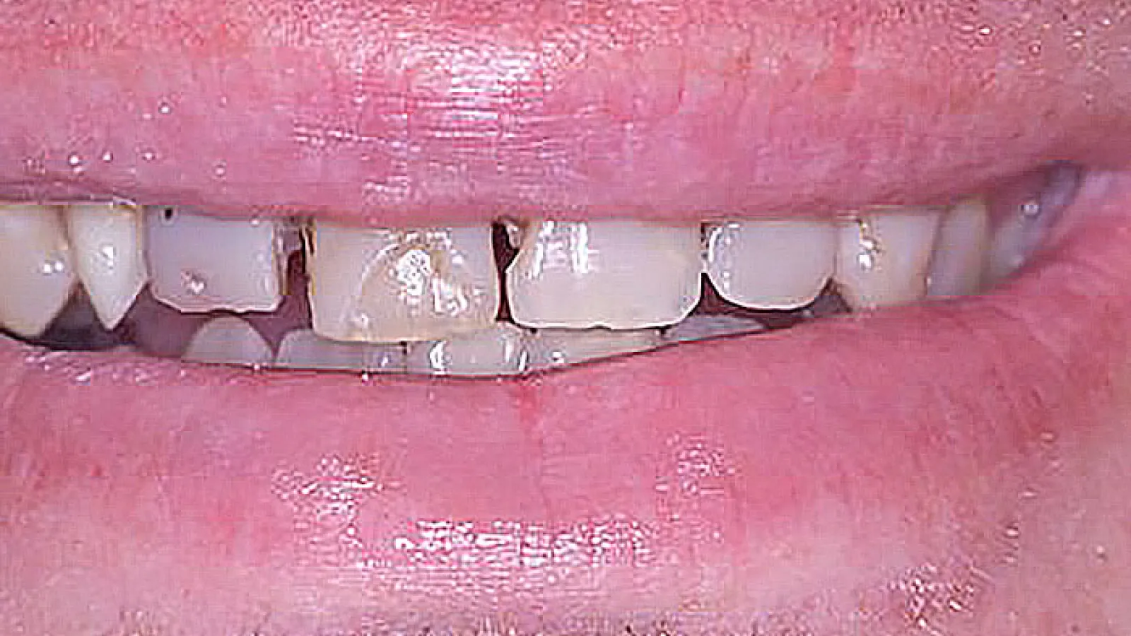 Close-up of a smile showing teeth with noticeable gaps and discoloration, emphasizing dental health concerns.