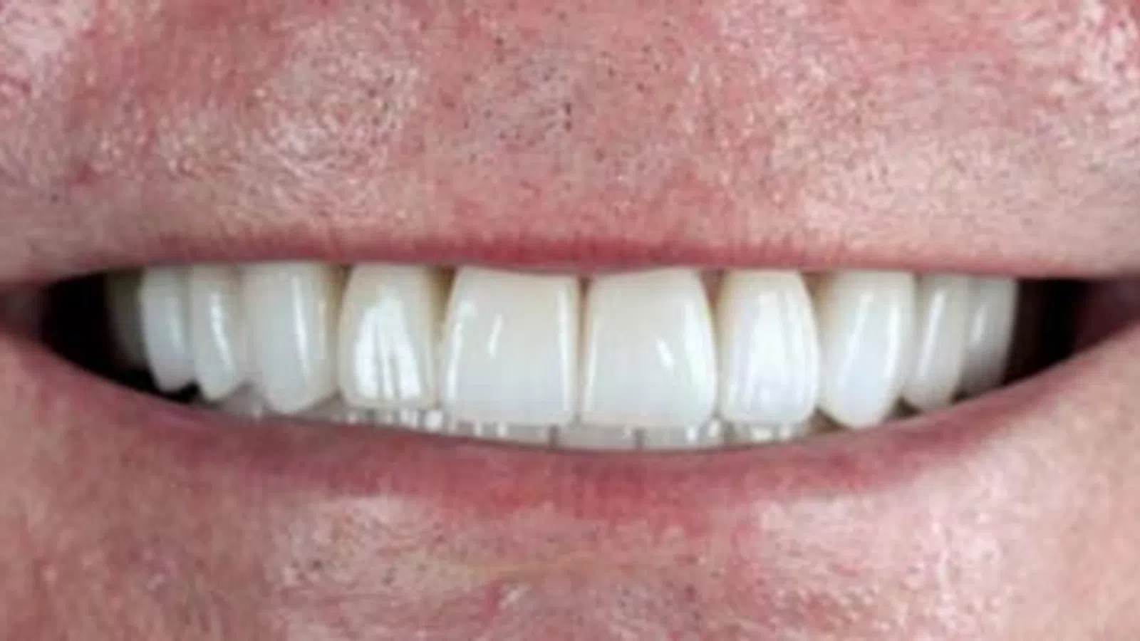 Close-up of a smiling person's mouth showing clean, white, well-aligned teeth and natural lips.