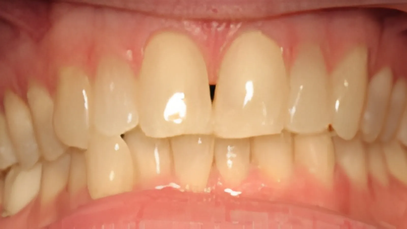 Close-up of adult upper and lower teeth with visible gaps and alignment irregularities under natural light.