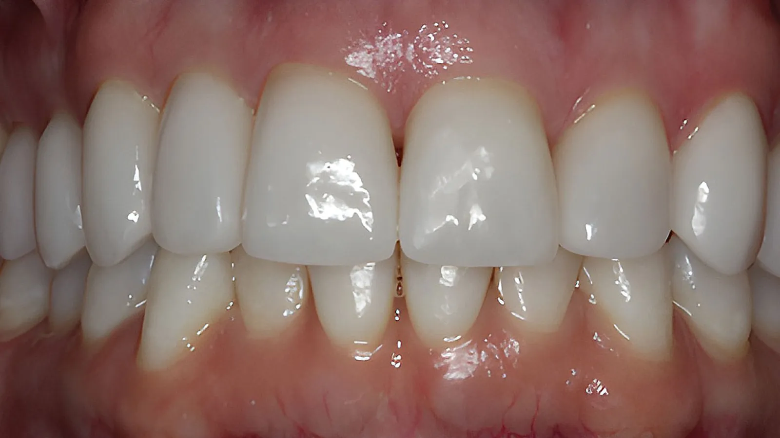 Close-up of healthy, clean white teeth and gums with natural shine and alignment.