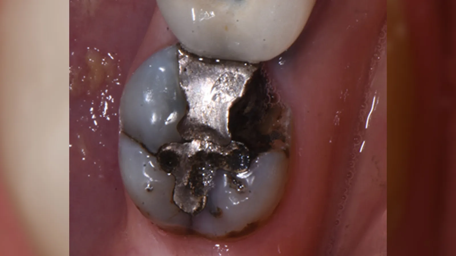 Close-up of a molar tooth with a damaged silver dental filling and visible decay on surrounding tooth structure.