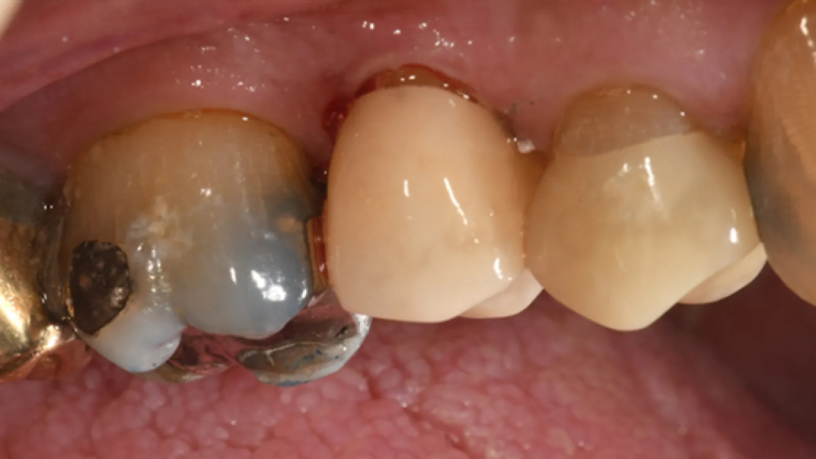 Close-up of human molars showing dental crowns and metal fillings with surrounding pink gum tissue.