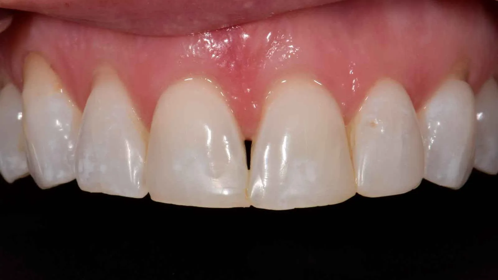 Close-up of upper front teeth showing a small gap and healthy pink gums against a black background
