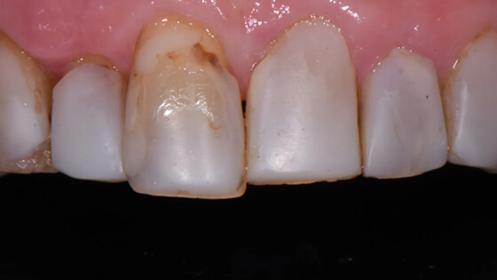 Close-up of upper front teeth showing visible tooth decay and discoloration on one tooth.