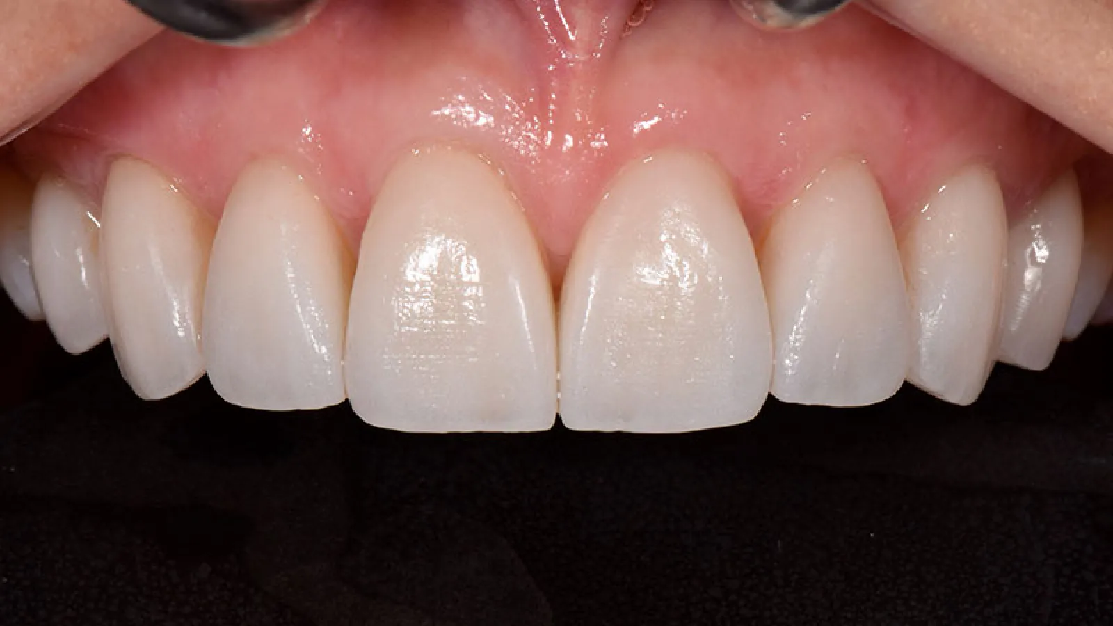 Close-up of healthy, clean, and white upper front teeth and gums against black background.