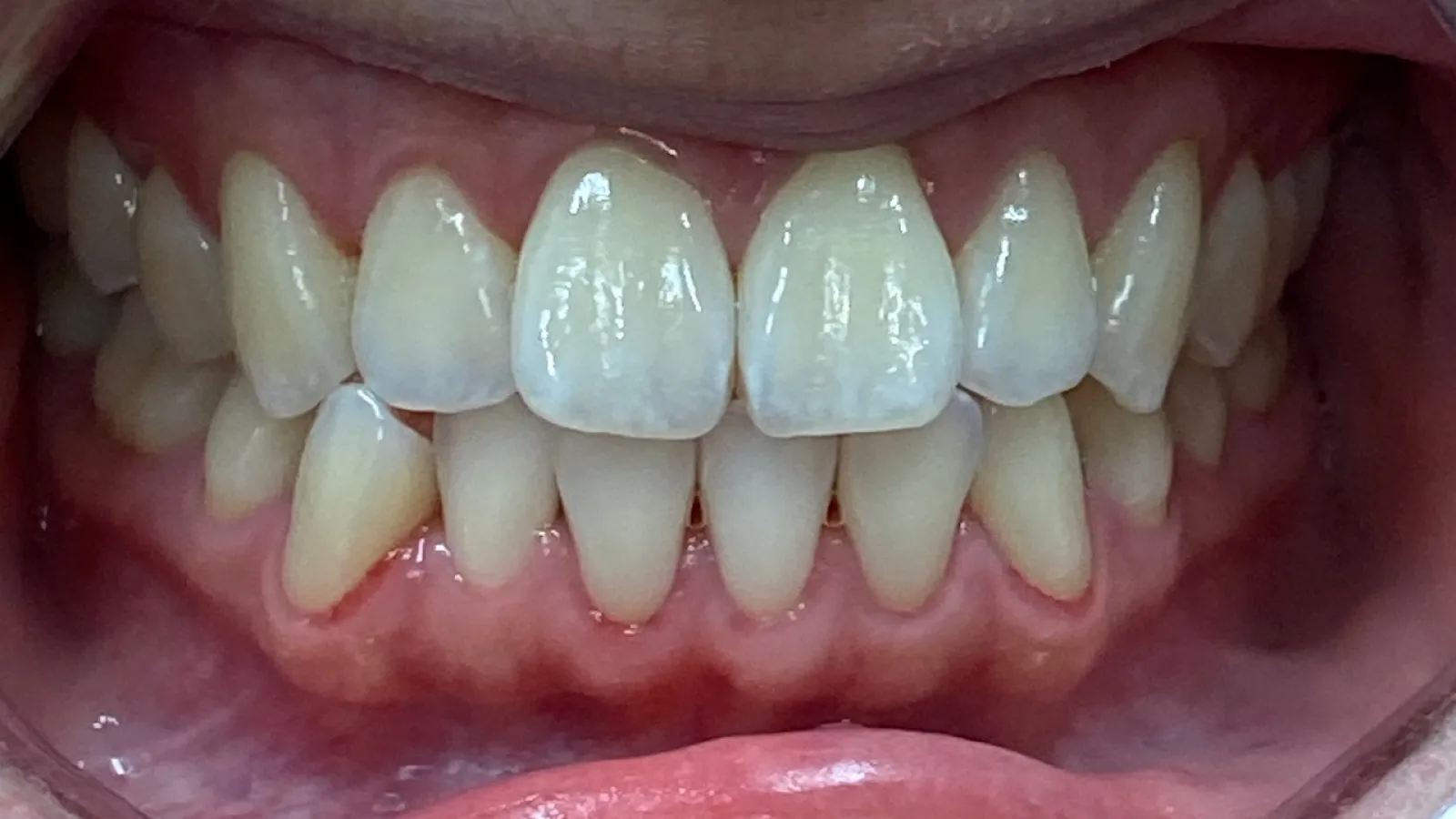 Close-up of a smile showing misaligned teeth with noticeable crowding on front lower teeth.