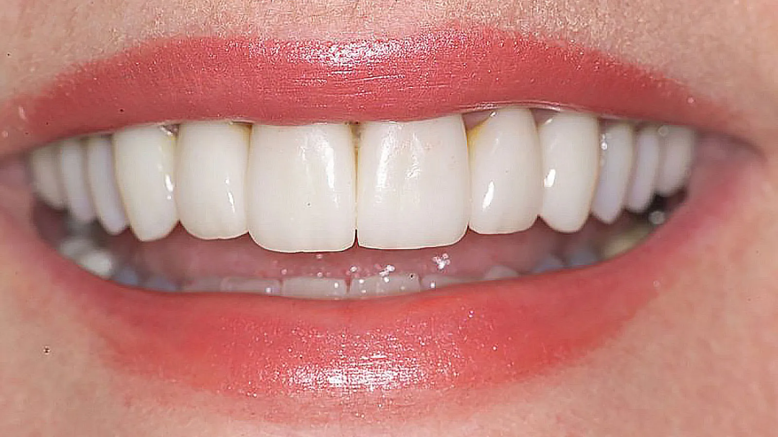 Close-up of a smile showcasing bright, straight teeth and a natural lip color.