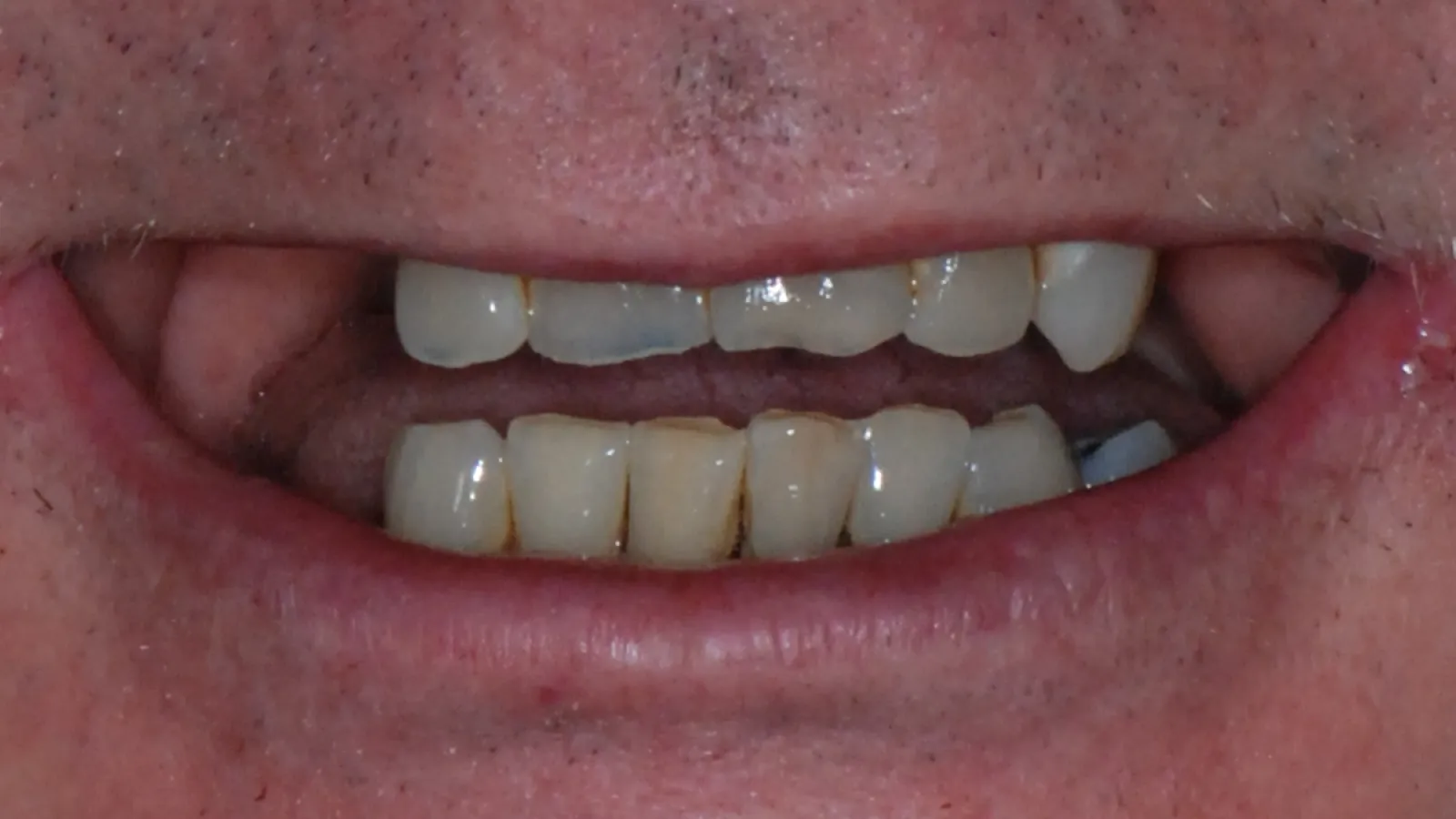 Close-up of a mouth with stained and uneven teeth showing dental discoloration and plaque buildup.