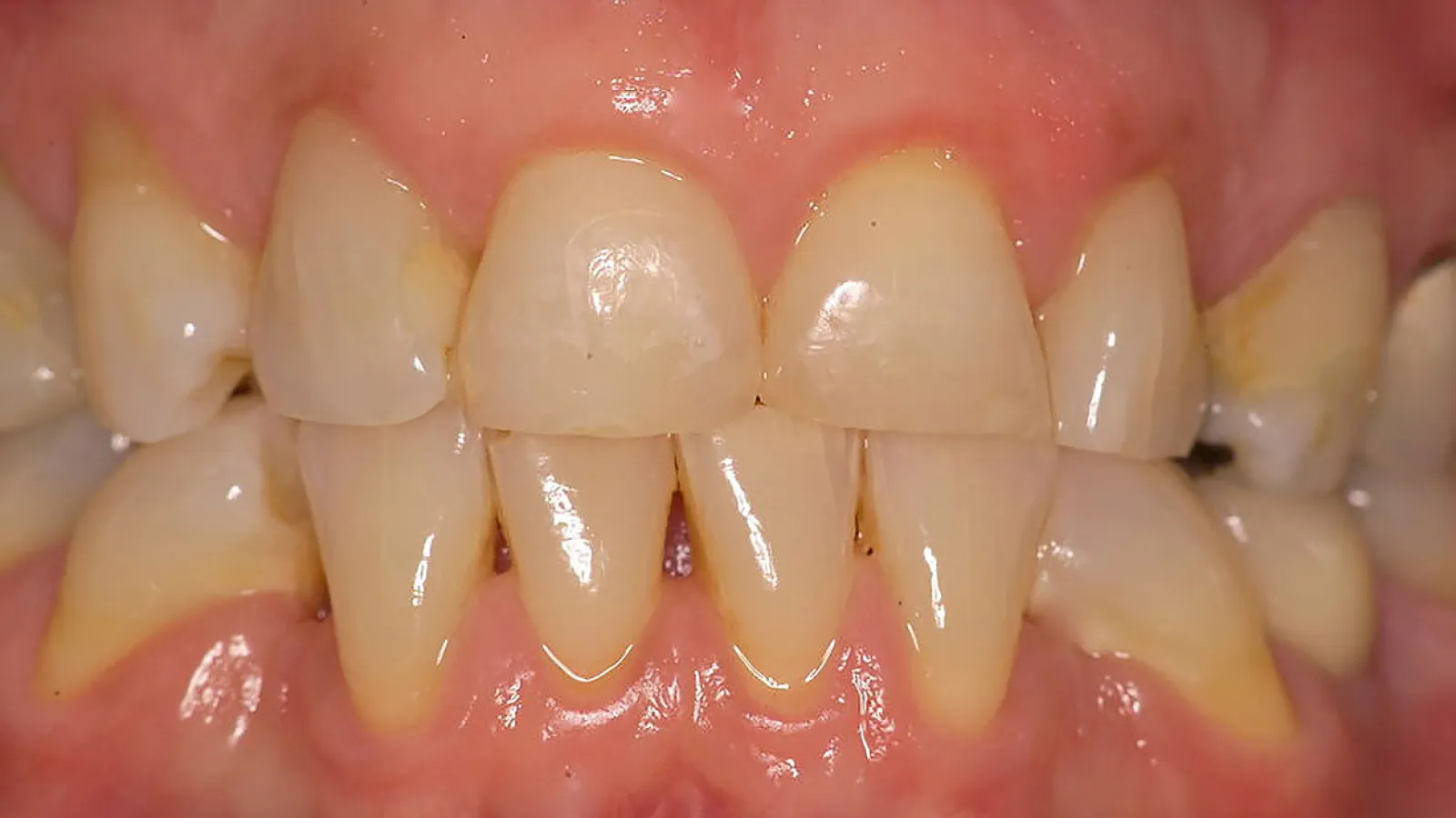Close-up of healthy human teeth showcasing clean enamel and gum line.