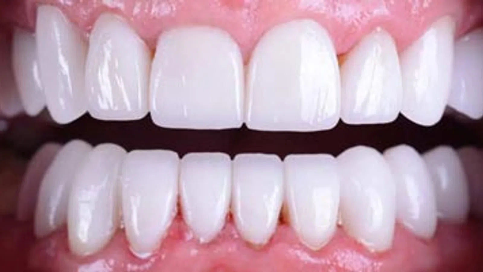 Close-up of healthy white upper and lower teeth with pink gums and no visible dental issues