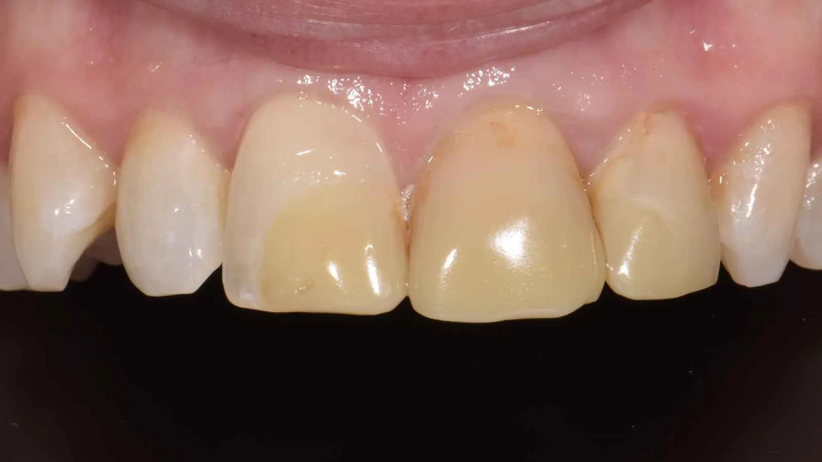 Close-up of upper front teeth showing yellow discoloration and stains on the enamel surface.