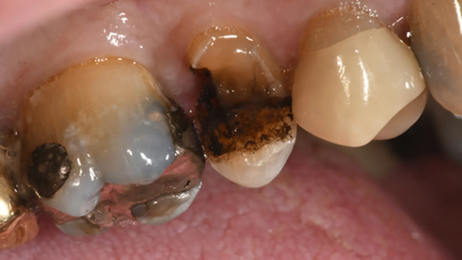 Close-up of severely decayed and damaged molar teeth with dark cavities and dental plaque visible.