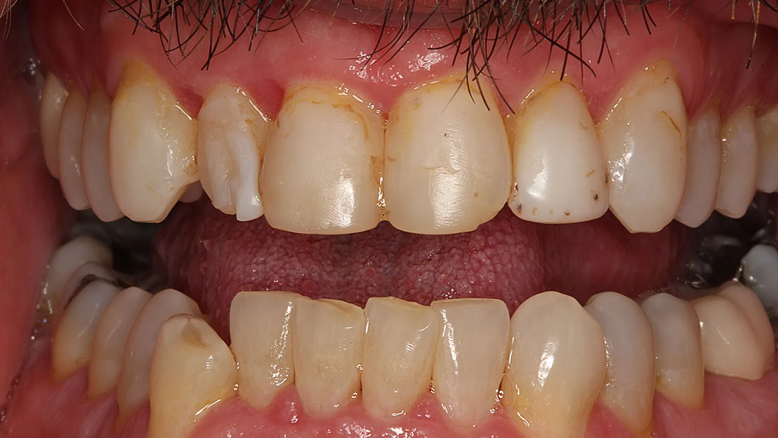 Close-up of stained and misaligned upper and lower teeth with visible plaque and gum redness.