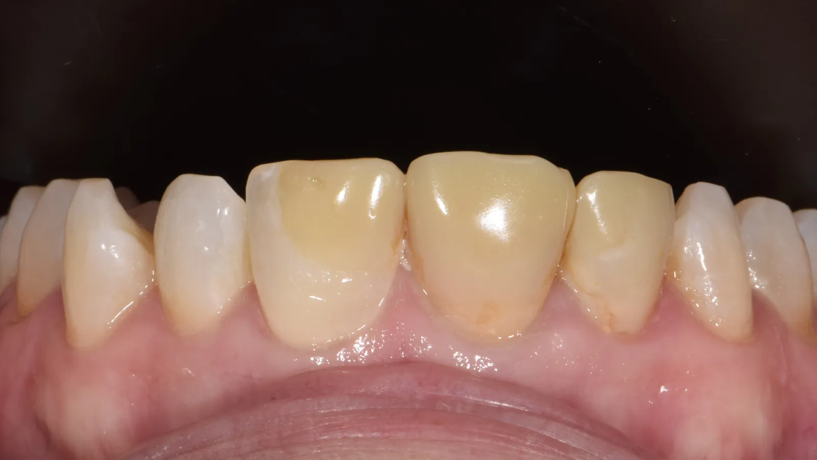 Close-up of upper front teeth showing discoloration and enamel wear on the incisors against a dark background