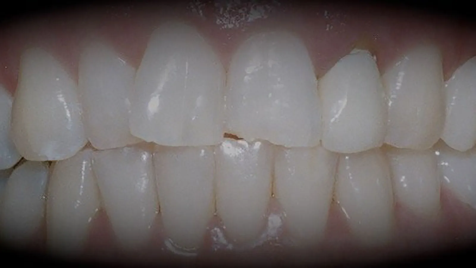 Close-up of healthy human teeth showing alignment and enamel clarity.