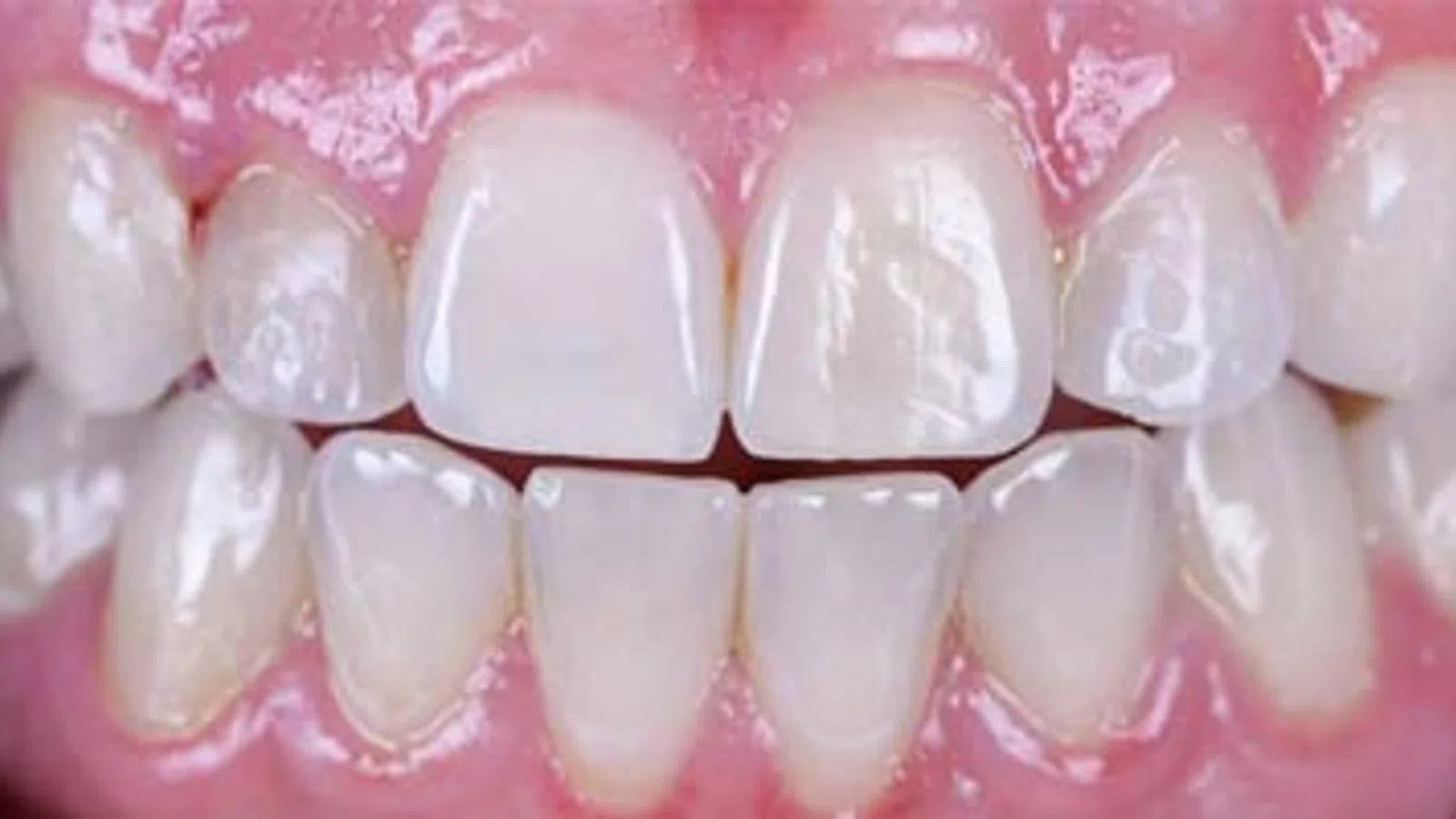 Close-up of healthy upper and lower front teeth with visible gums and natural tooth texture.