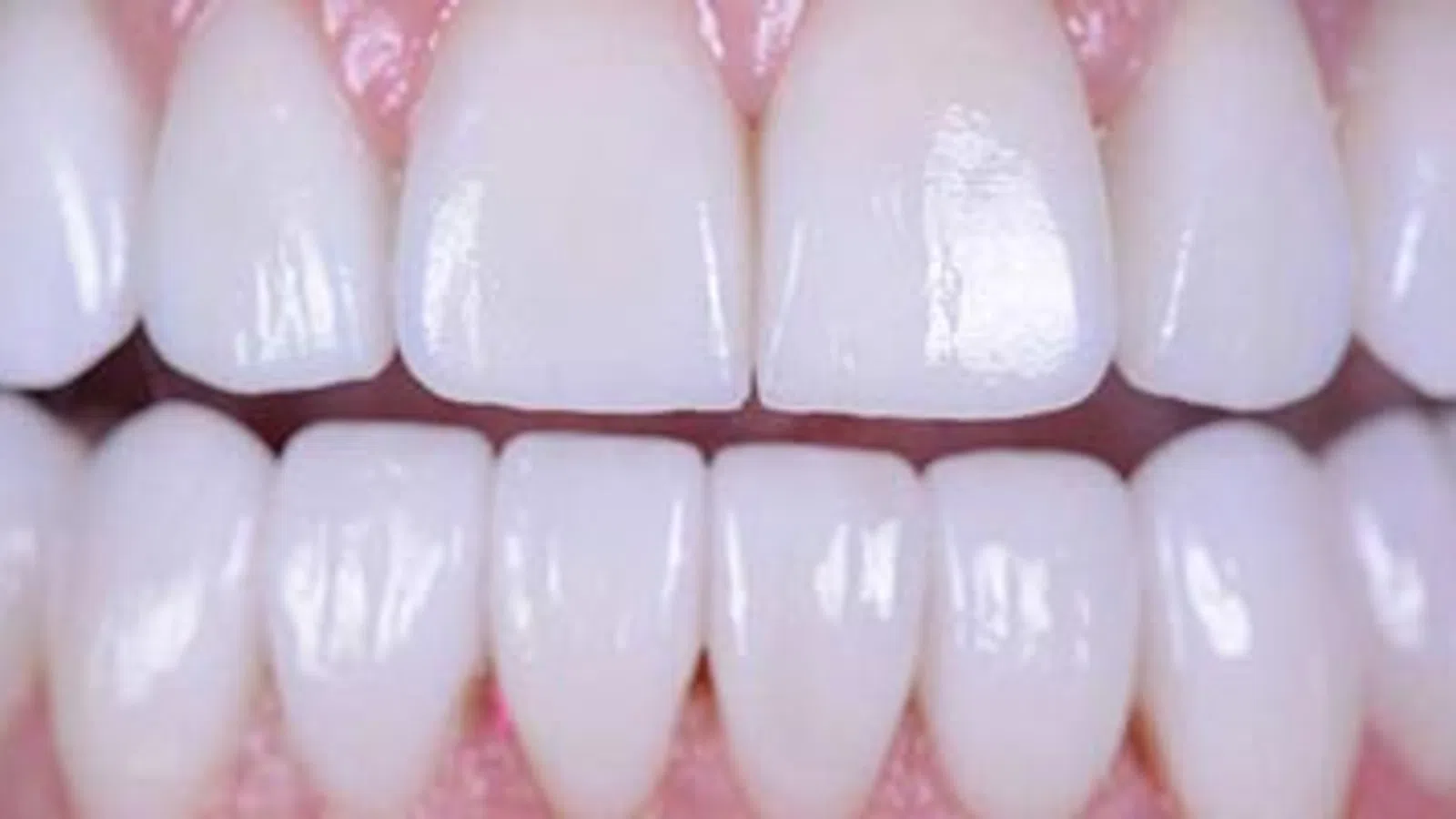 Close-up of clean, healthy white teeth showing upper and lower front teeth and pink gums.