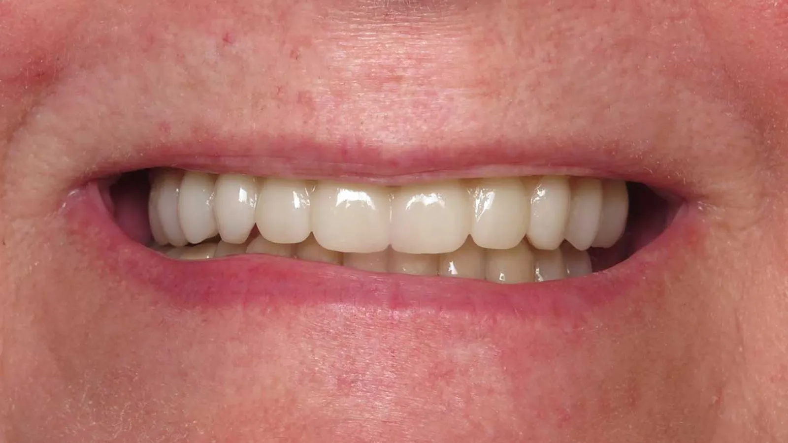 Close-up of a smiling mouth showing white, even dental crowns and healthy gums.