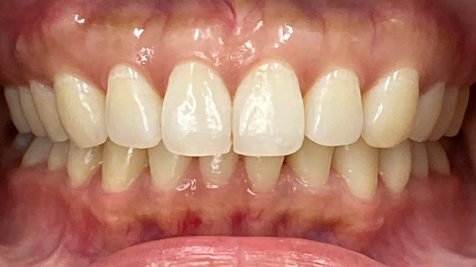 Close-up of healthy upper and lower teeth with natural gums and lips visible in a bright smile.