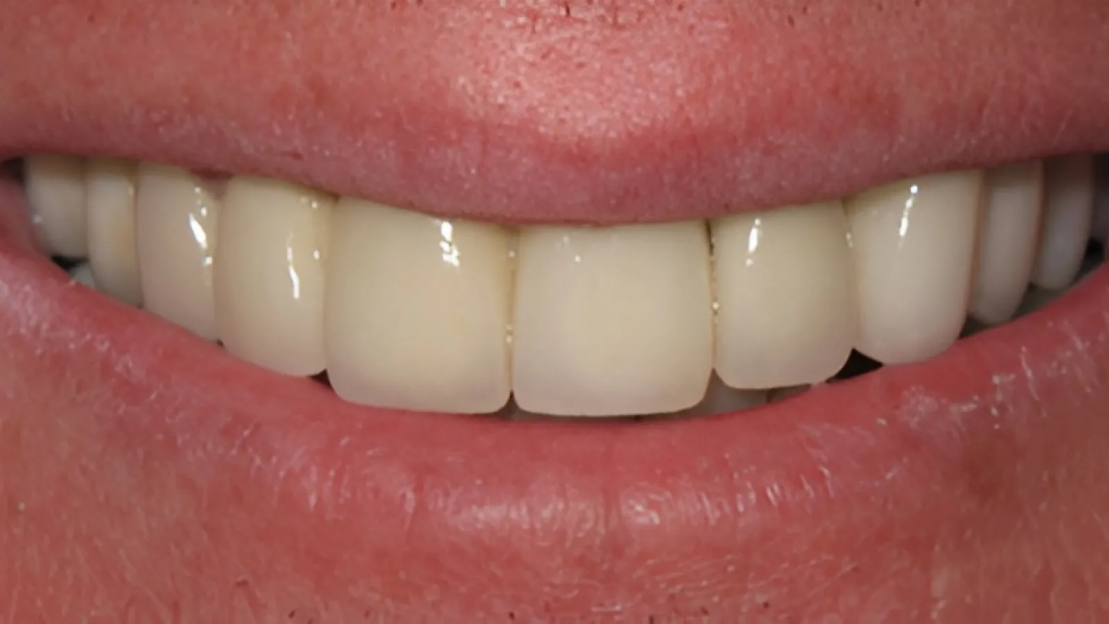 Close-up of a smiling mouth showing clean, white, evenly aligned teeth and natural pink lips.