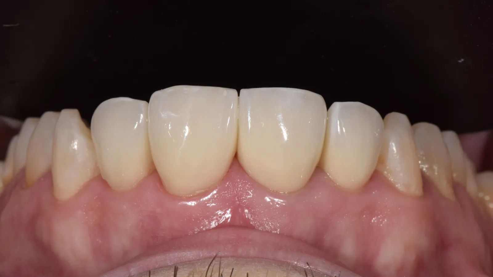 Close-up of healthy upper front teeth and gums with natural color and texture under bright lighting.