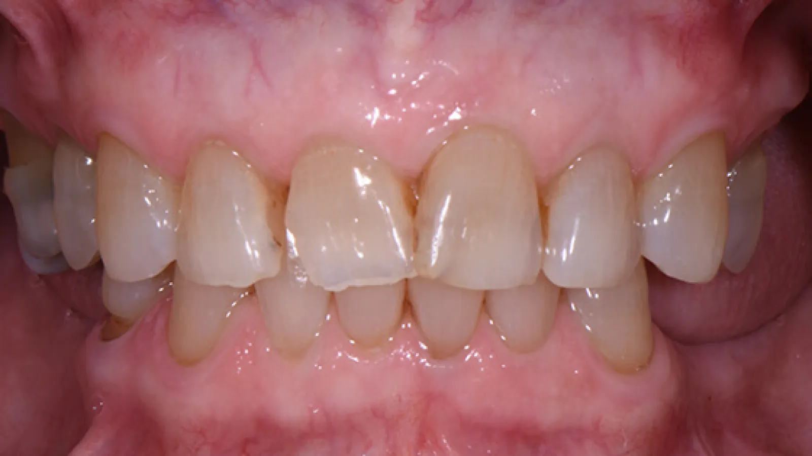 Close-up of upper and lower teeth showing slight discoloration and gum details in a human mouth.
