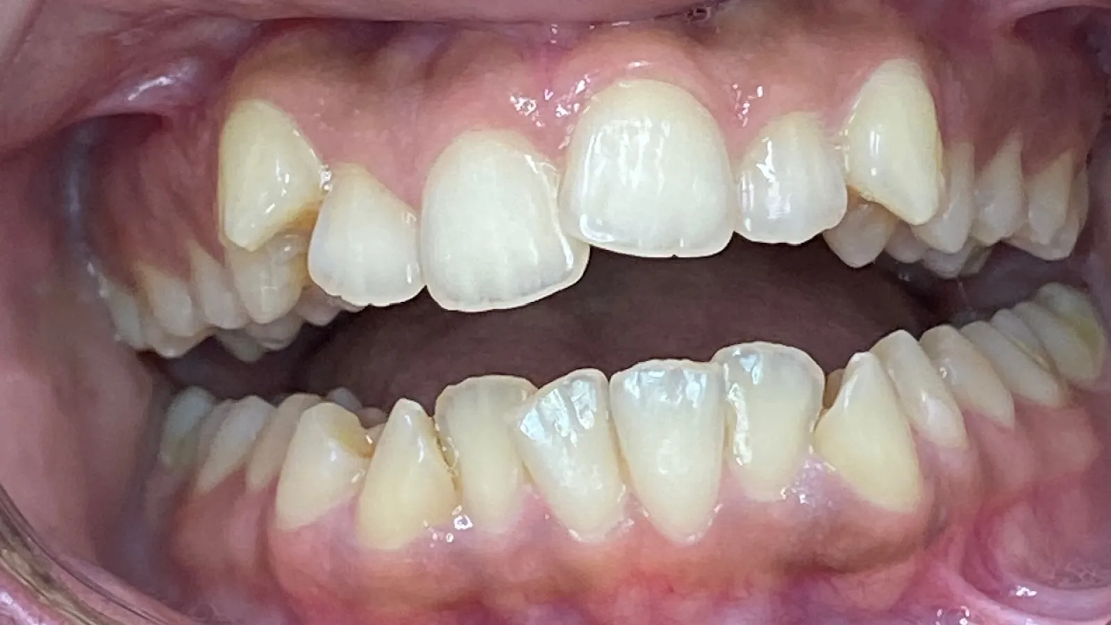 Close-up of a mouth showing misaligned and crowded teeth with visible gums and open bite.