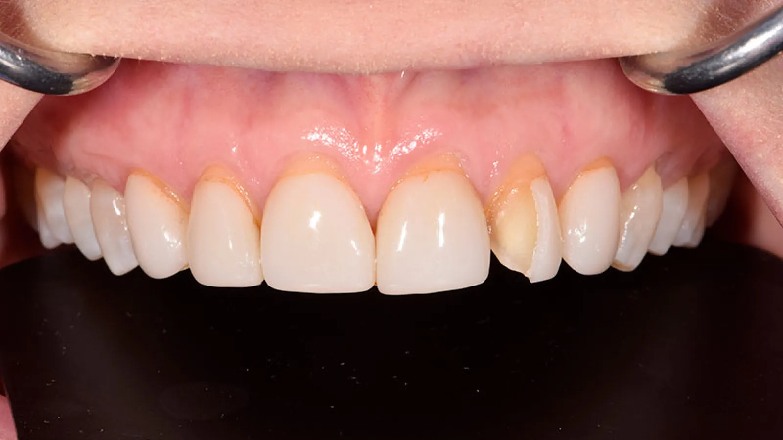 Close-up of upper front teeth with visible discoloration and dental issues on one tooth.