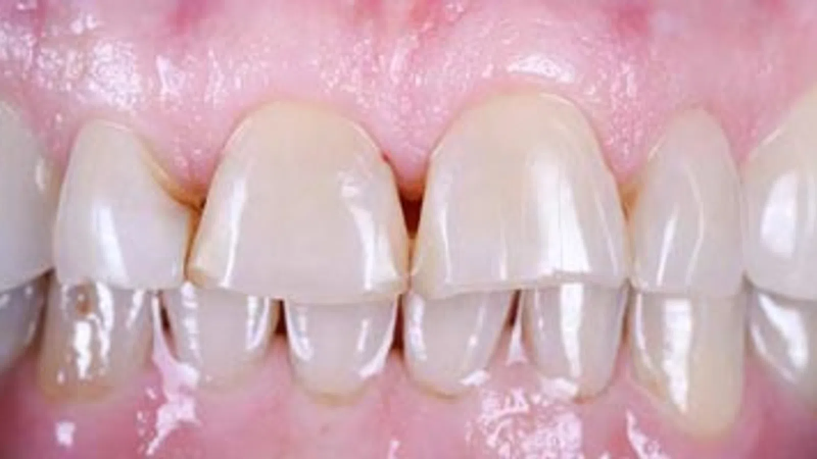 Close-up of healthy upper front teeth and pink gums with natural shine and texture.