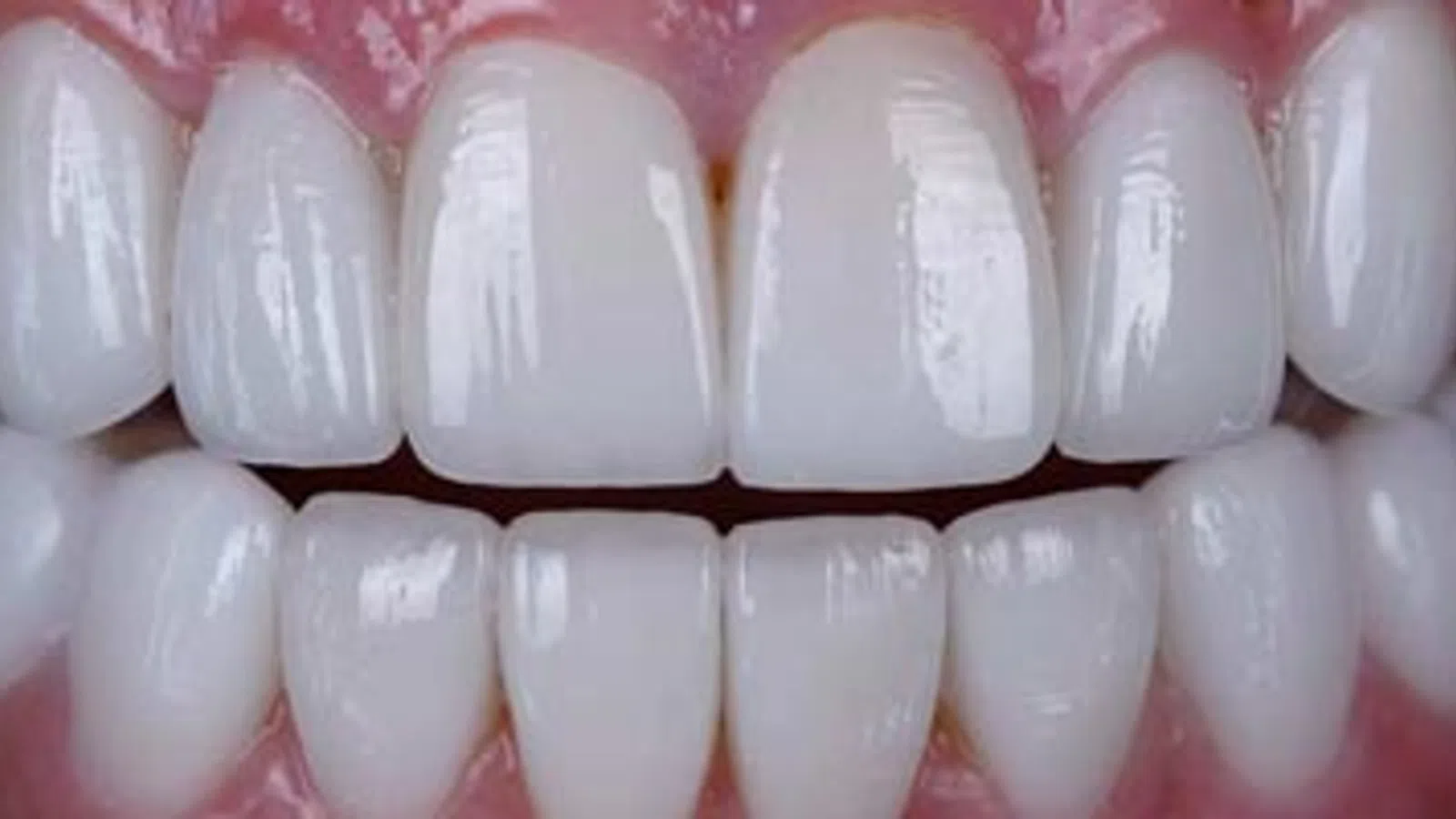 Close-up of bright white, healthy upper and lower human teeth with gums visible in natural lighting