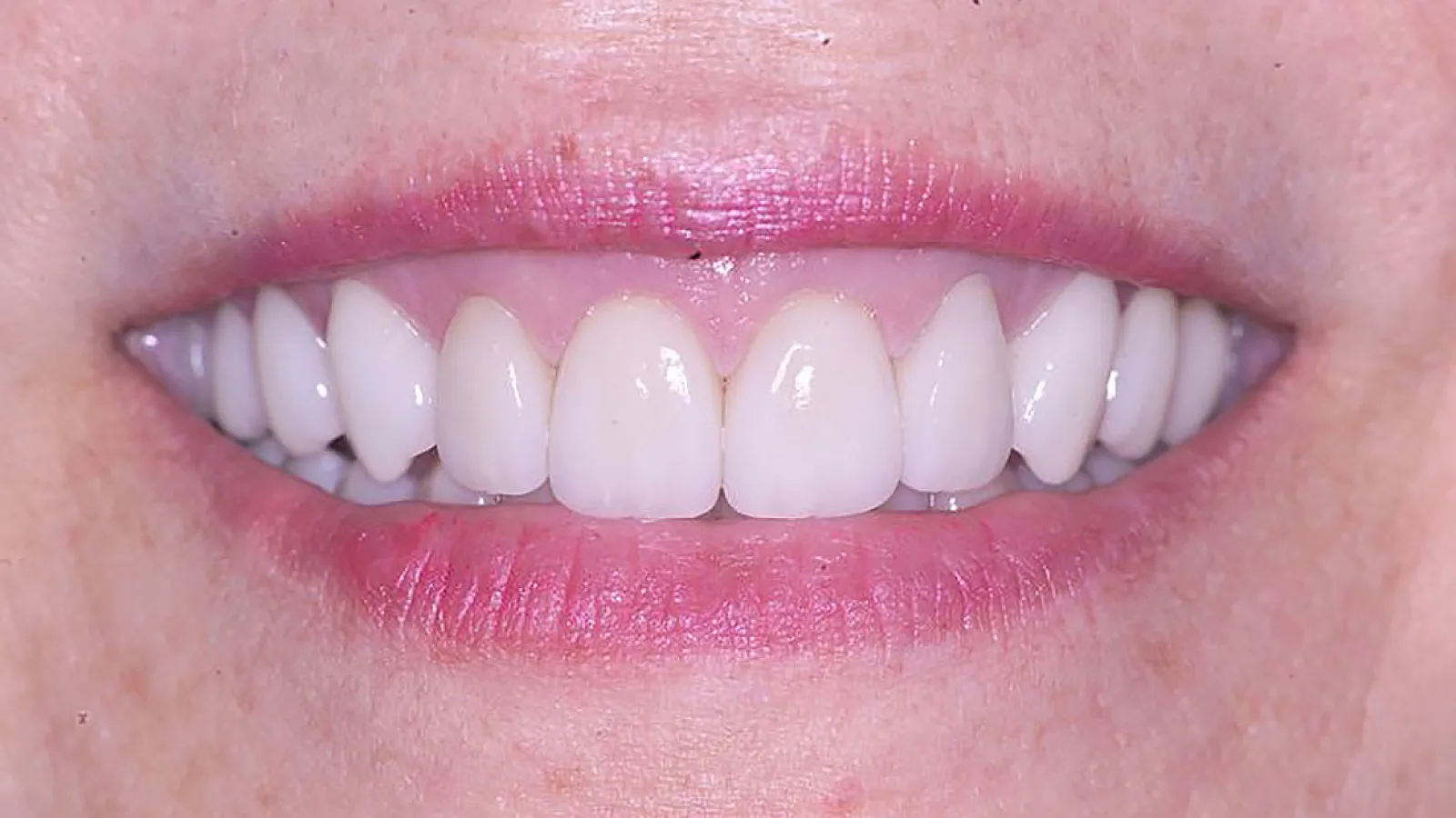 Close-up of a smiling mouth with bright, even teeth and pink lips creating a healthy appearance.
