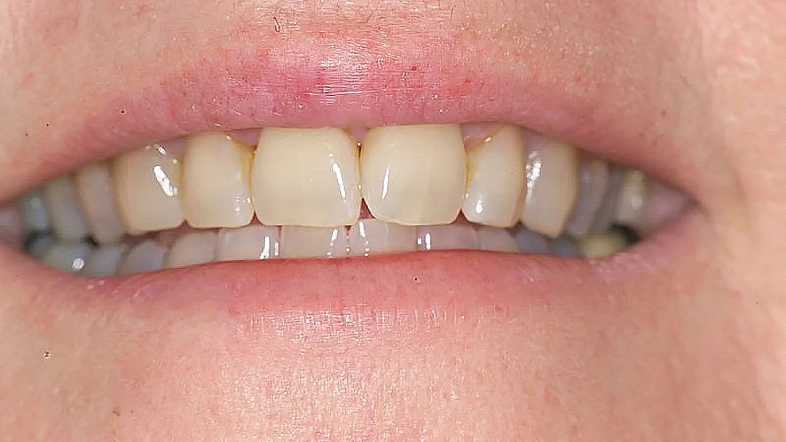 Close-up of a person smiling, showcasing healthy, straight teeth and pink gums.