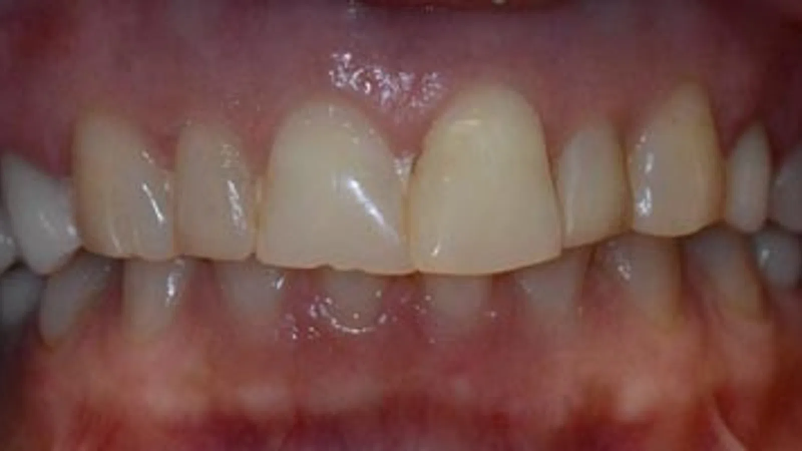 Close-up of human teeth showing dental alignment and gum details under natural lighting.
