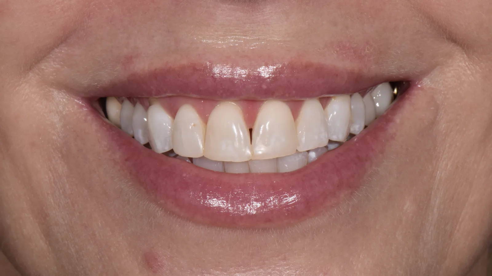 Close-up of a smiling mouth showing natural teeth with a small gap between the front teeth.