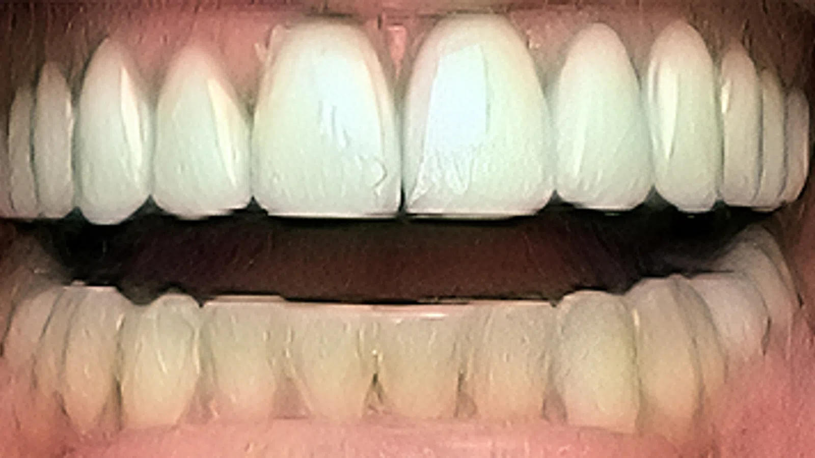 Close-up of upper and lower teeth showing natural tooth alignment and color with slight gaps