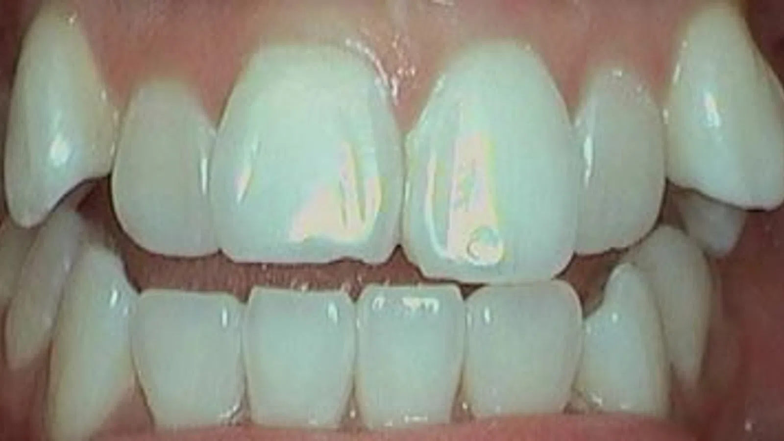 Close-up of a mouth showing crooked and misaligned teeth with crowding in both upper and lower arches