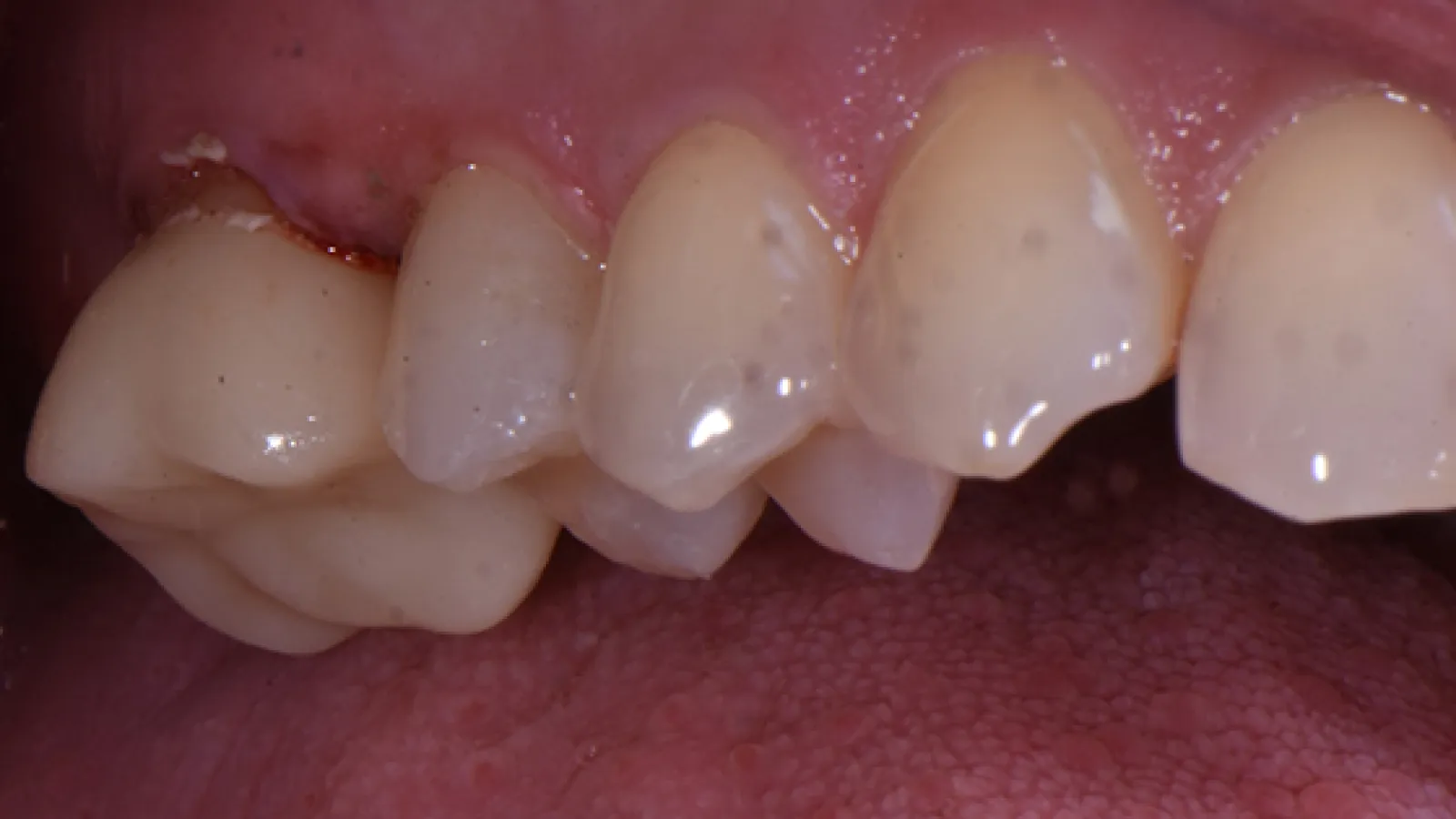 Close-up of upper teeth showing dental plaque, stains, and slight gum inflammation inside the mouth.