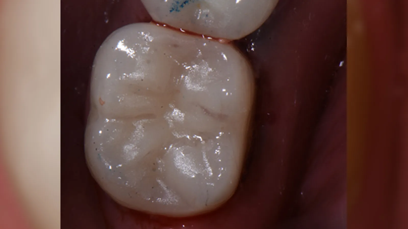 Close-up of a healthy molar tooth showing detailed grooves and smooth enamel surface under bright light.