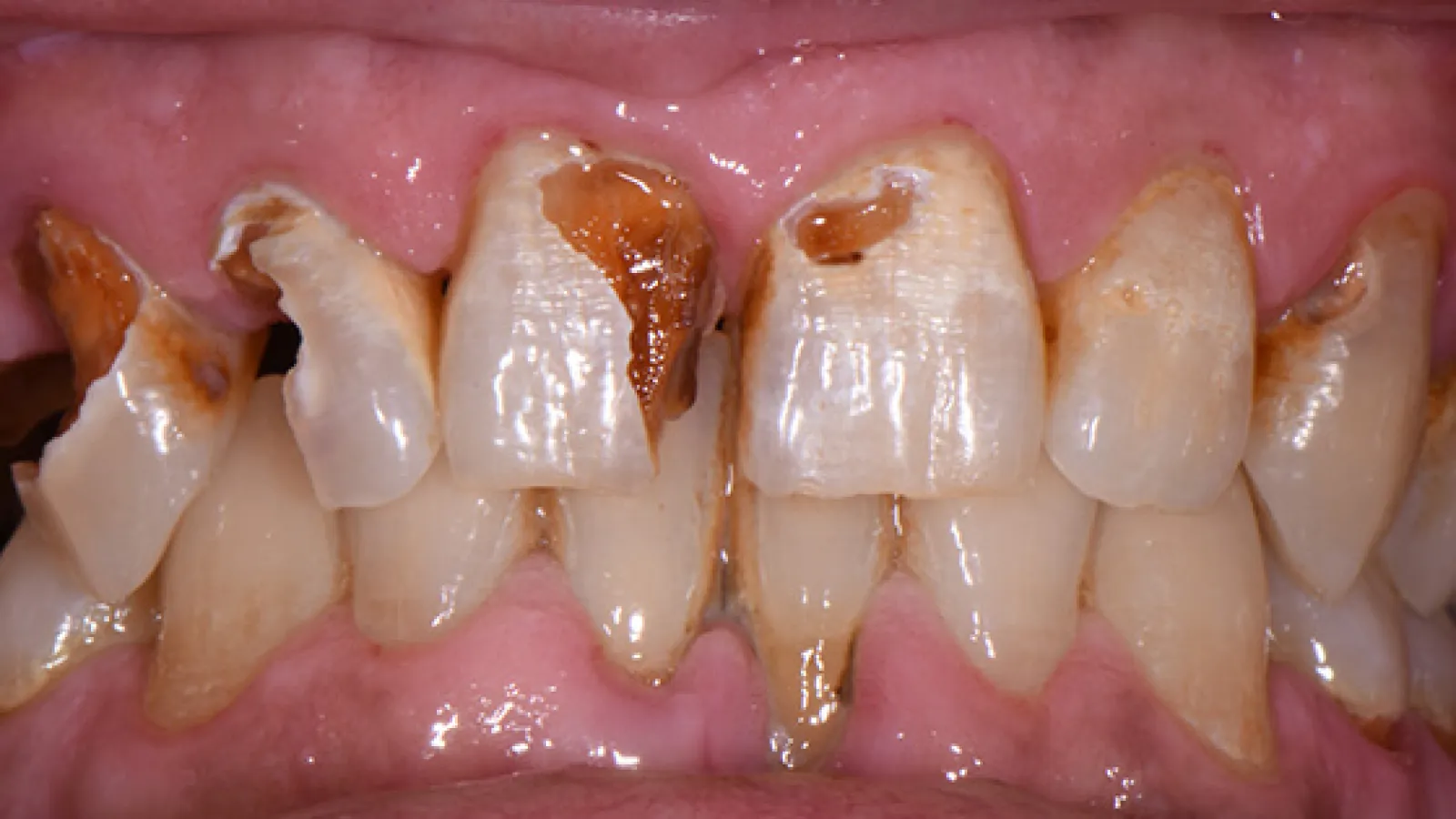 Close-up of severely decayed and damaged upper front teeth with visible cavities and discoloration.