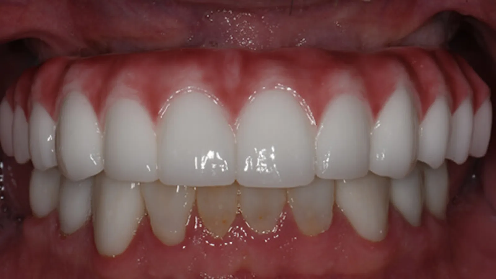 Close-up of teeth with upper dental veneers covering natural teeth, showing a contrast with lower stained teeth.