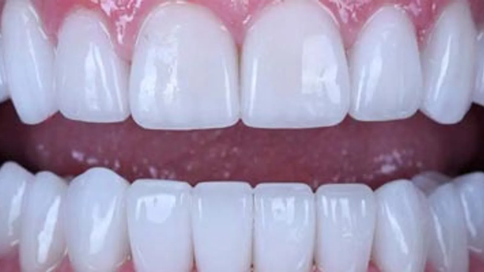 Close-up of clean, white upper and lower teeth with healthy pink gums and natural shine